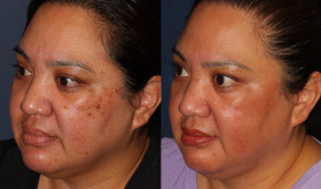 Kinh nghiệm trị nám “sạch sành sanh” cho những ai lần đầu tiên trị nám