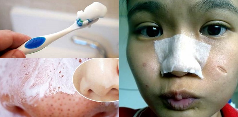 Lấy bàn chải cũ nhúng vào thứ này rồi chà lên mũi, mụn đầu đen nhiều cỡ nào cũng bật lên hết sạch