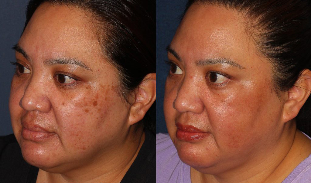 Kinh nghiệm trị nám “sạch sành sanh” cho những ai lần đầu tiên trị nám