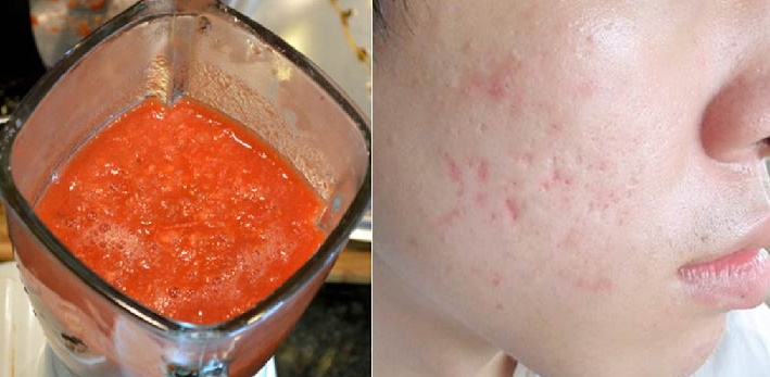Cà phẳng sẹo lồi, lấp đầy sẹo lõm, xóa sạch sẹo thâm nhờ hỗn hợp "vi diệu" này