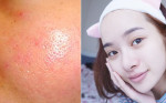 Lỗ chân lông to, cần chăm sóc như thế nào mới thu nhỏ lại