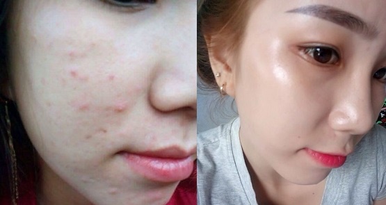 Top 7 lời khuyên giúp bạn "bái-bai" lũ mụn trong mùa hè nóng bức