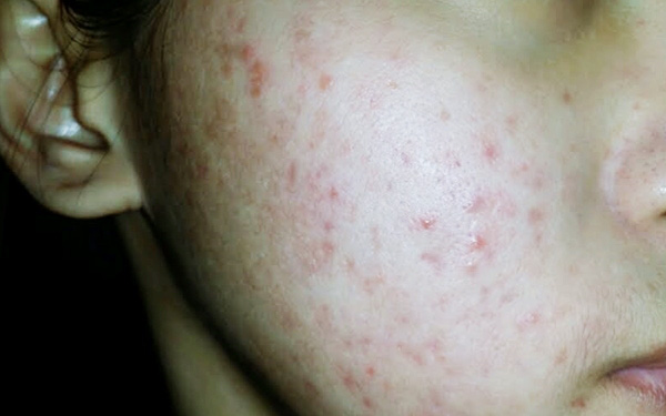 Kế hoạch 7 ngày giúp đẩy lùi mụn, da trắng sáng ngay tại nhà