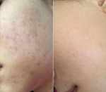 Mụn nội tiết cũng sạch bay trong 1 nốt nhạc nhờ bí kíp của bà mẹ 1 con