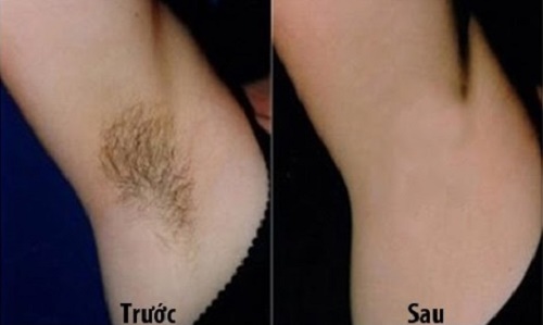 Phát ham với tuyệt chiêu làm lông nách biến mất vĩnh viễn chỉ trong 2 phút không cần nhíp