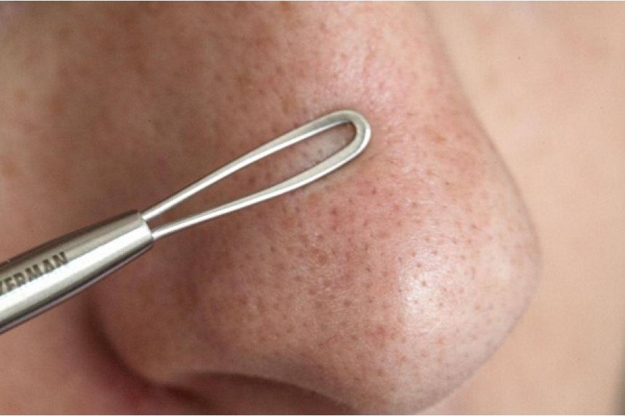 Tuyệt đối tránh xa vùng "tam giác tử thần" và những sai lầm khi nặn mụn