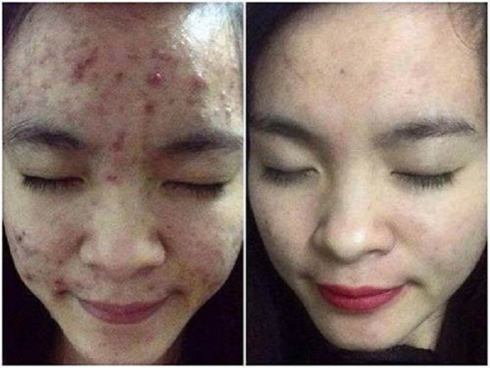 Vừa trị mụn, lại se khít lỗ chân lông hiệu quả chỉ với lon bia 10k