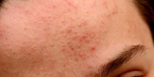 Bí kíp tận diệt sạch mụn ẩn, mụn li ti chỉ trong 1 nốt nhạc