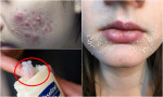 Đừng bao giờ bôi 7 thứ này lên mặt nếu không muốn mụn nở hoa