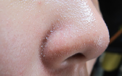 Mách bạn cách trị mụn cám đơn giản và hiệu quả