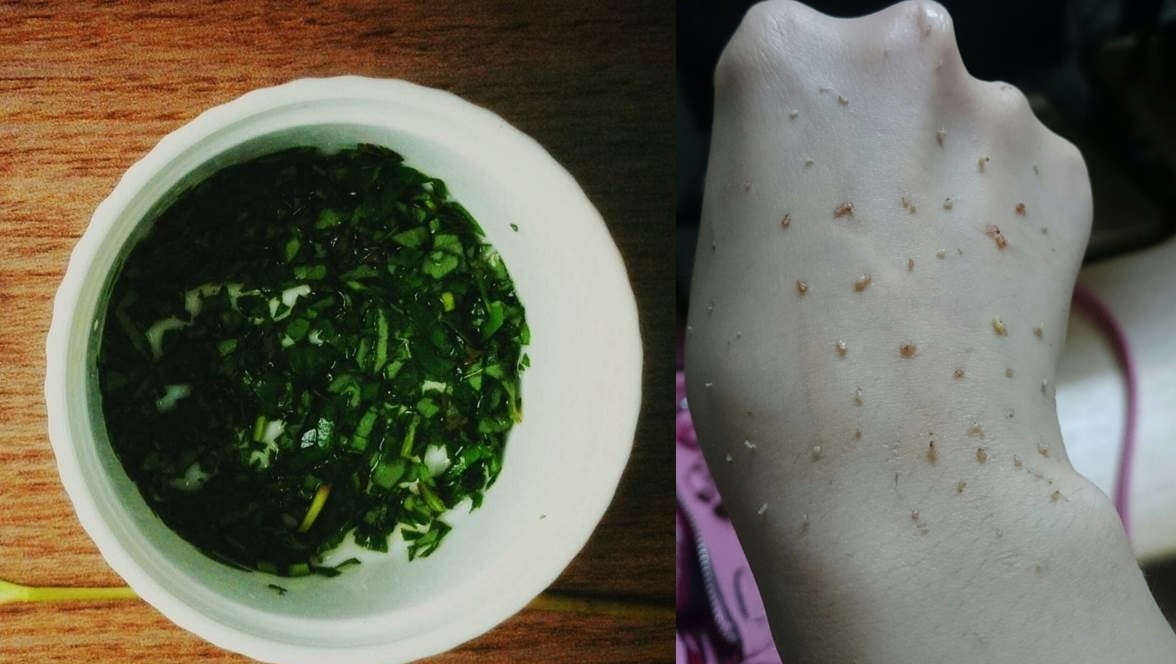 3 cách &rsquo;THỔI BAY&rsquo;  mụn đầu đen giúp lỗ chân lông se khít