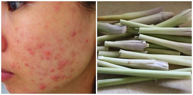 Tự chế công thức trị mụn từ 5k bó sả + 1k đá viên, da nhờn mụn cỡ nào cũng láng o, sạch mụn.