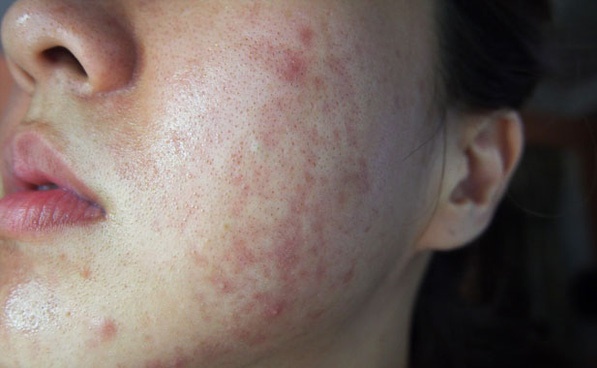 3 thực phẩm tuyệt đối tránh khi bị dị ứng da mặt