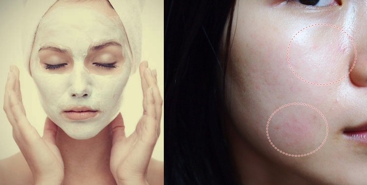 Coi chừng mặt đầy mụn và xấu đi vì đắp mặt nạ sai cách
