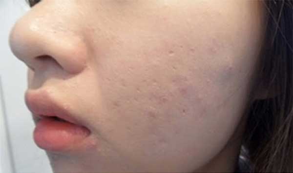 Mụn ẩn dưới da và cách chữa trị hiệu quả nhất quả đất