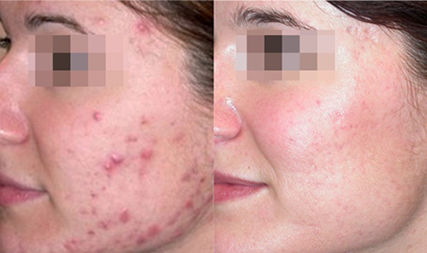 Mụn bọc hay sẹo thâm nhiều đến mấy cũng bị đánh bật trong vòng 1 tháng nhờ đông lạnh thứ này