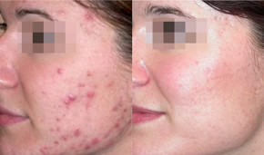 Mụn bọc hay sẹo thâm nhiều đến mấy cũng bị đánh bật trong vòng 1 tháng nhờ đông lạnh thứ này