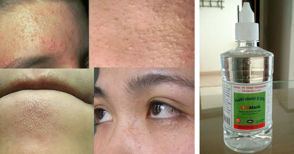 Chỉ rửa mặt bằng nước này hàng ngày, ai bị mụn hết ngay, dị ứng cũng chữa khỏi