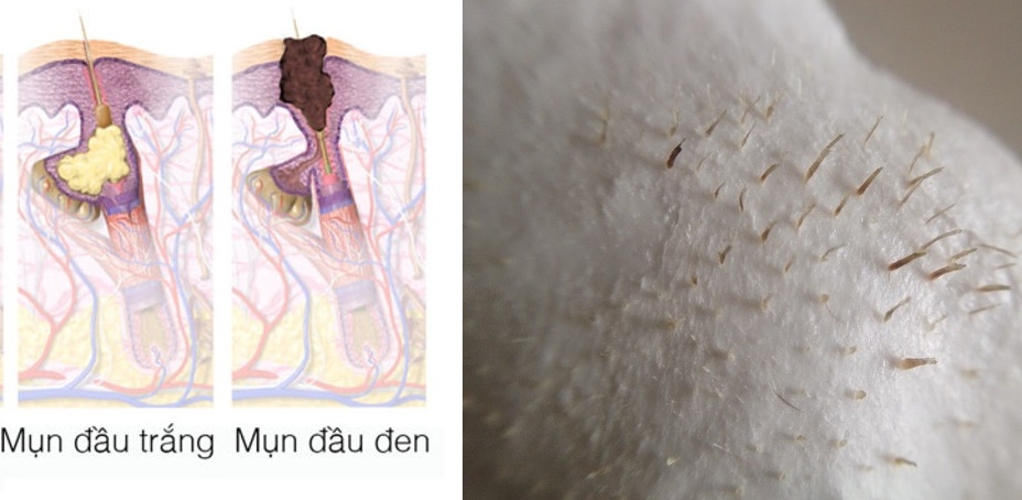Muốn da đẹp đừng nhầm lẫn những "chấm li ti" này là mụn đầu đen nữa