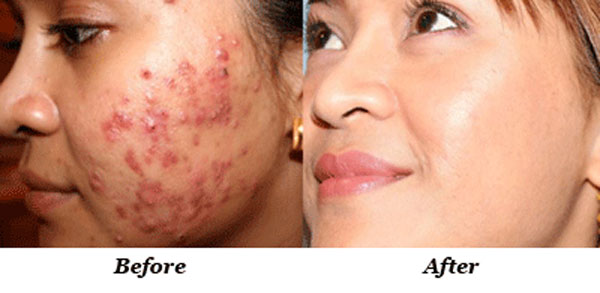 Nếu bị mụn, bạn sẽ mua ngay 1 chai nước muối sinh lý về rửa mặt ngay khi đọc bài này