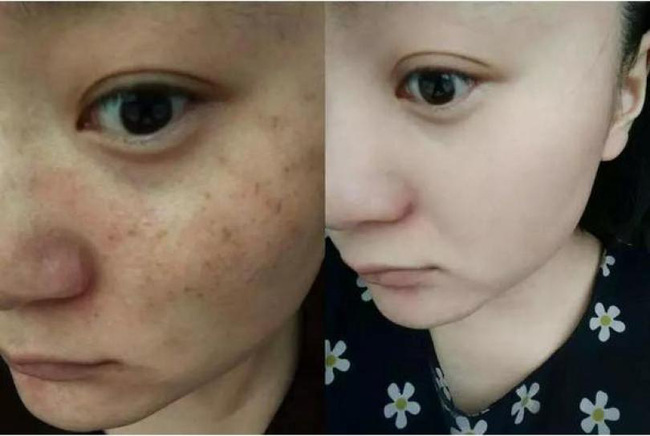 Thoa nước này mỗi ngày, da sẽ trắng hồng, vết nám hoàn toàn bay biến