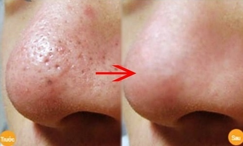 Lỗ chân lông to cỡ nào cũng phải “thu mình” nhỏ lại chỉ nhờ 1 mớ rau răm