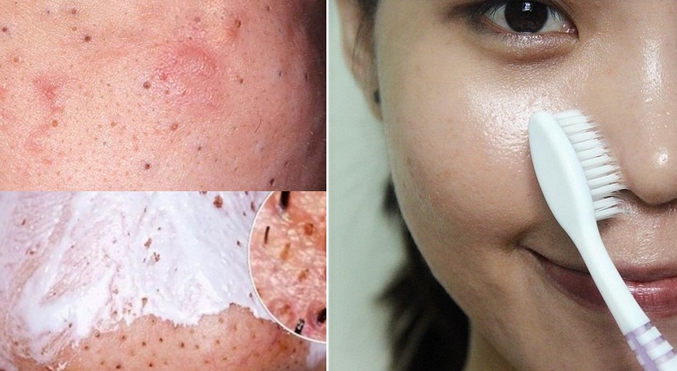 Giật mình với 2 cách làm mụn đầu đen tự khắc chui ra mà không cần nặn chỉ bằng 1 chiếc bàn chải đánh răng cũ