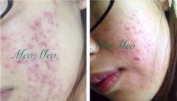 Cô gái trị mụn thâm nhanh trong chớp mắt chỉ nhờ cách chăm sóc đơn giản thế này đây