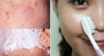 Giật mình với 2 cách làm mụn đầu đen tự khắc chui ra mà không cần nặn chỉ bằng 1 chiếc bàn chải đánh răng cũ