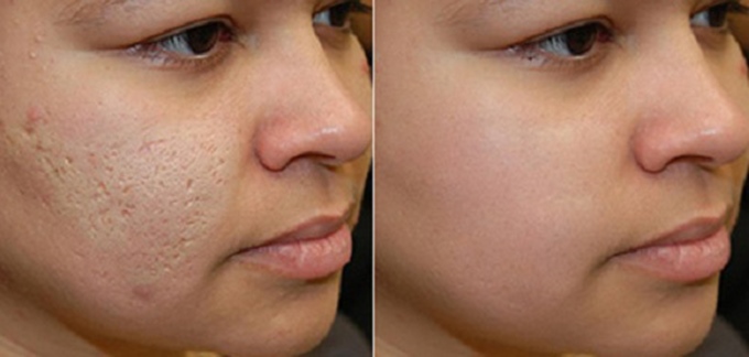 Lấp đầy sẹo rỗ lâu năm chỉ bằng 1 vỉ vitamin E có giá hơn chục nghìn đồng