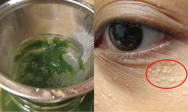 Xay nhuyễn lá tía tô trộn với thứ này thoa 3 lần/tuần, mụn thịt quanh tự động tiêu biến