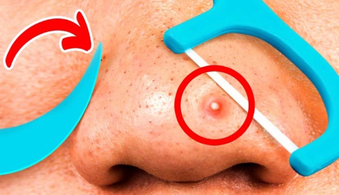 6 SAI LẦM MÀ MỌI NGƯỜI LUÔN LẦM TƯỞNG TRONG VIỆC TRỊ MỤN