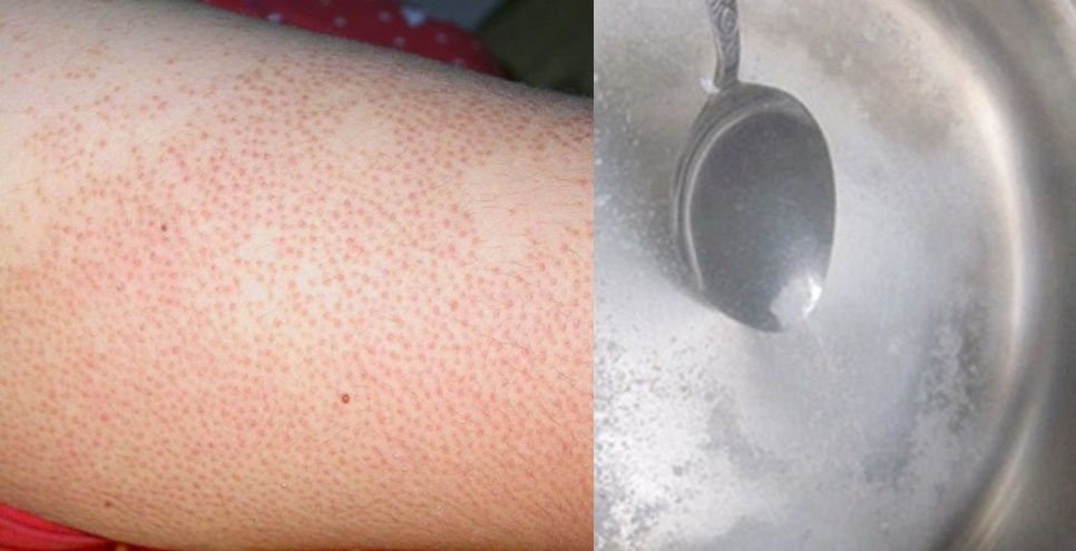 Viêm nang lông nhiều và dày đặc sẽ khỏi mãi mãi chỉ nhờ 1 thìa muối