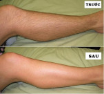 Đun nhừ lá trầu không chà đến đâu, lông chân tay rụng luôn đến đấy