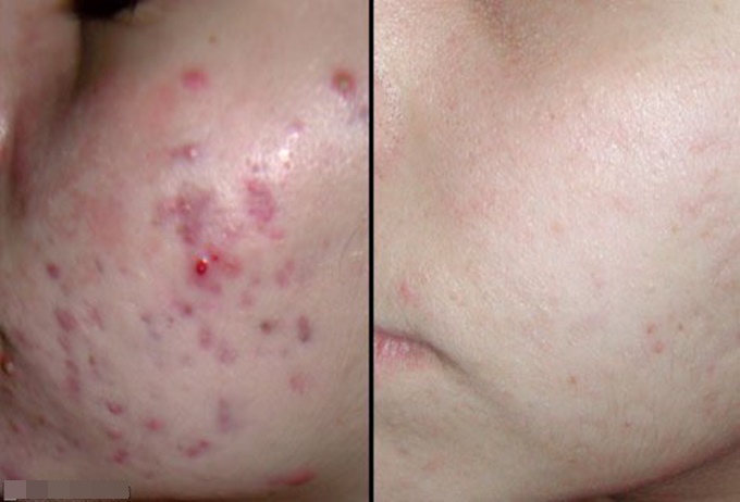 Mụn loại nào cũng khỏi, hết thâm, da trắng mịn nhờ nồi nước này