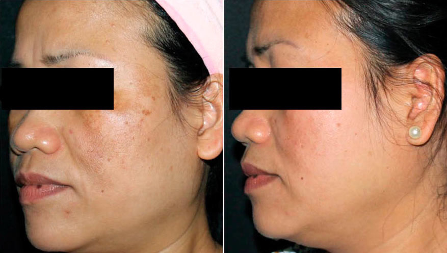 2 PHÚT MỖI NGÀY CHO LÀN DA HẾT SẠCH NÁM, TRẮNG MỊN TỪ BÊN TRONG