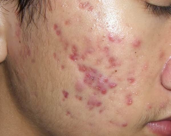 Đây chính là thần dược trị thâm một phát ăn ngay chỉ với vài ngàn đồng