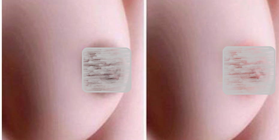 Nhũ hoa thâm đen đến mẫy cũng trở nên hồng hào sau 2 tuần nhờ các nguyên liệu có sẵn trong bếp này