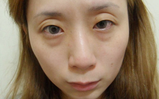 Chữa mắt thâm quầng trong tích tắc nhờ cách làm đơn giản này