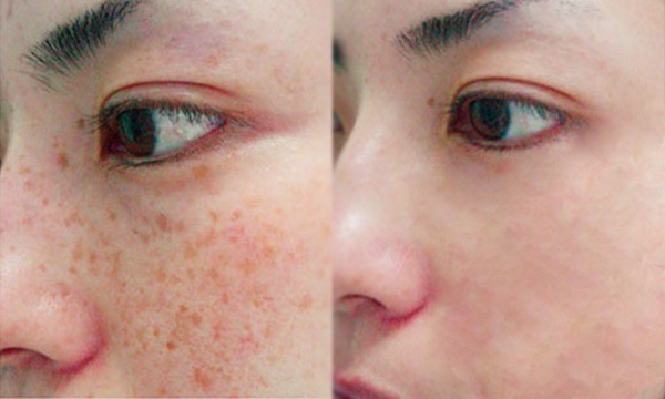 Trị nám hiệu quả vĩnh viễn nhờ uống nước rau ngót theo cách này