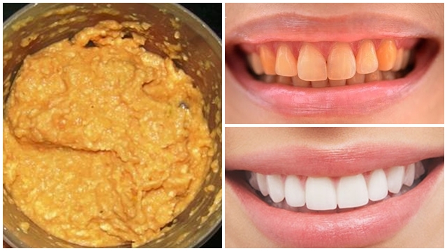 Không đủ tiền đập đi xây lại, em chỉ dùng nắm lá này thôi mà sau 1 tuần răng trắng bóc