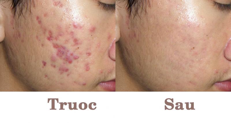 Cách "diệt sạch" mụn trứng cá hiệu quả sau 1 đêm