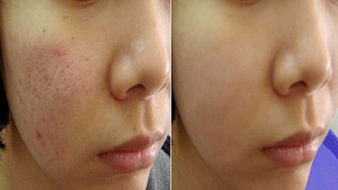 Sẹo lõm, sẹo rỗ lấm tấm như hạt đỗ cũng &rsquo;lấp đầy&rsquo; chỉ với 1 vỉ vitamin E