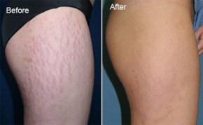 “Bí kíp” xóa sạch rạn da siêu nhanh nhờ trộn 1 thìa này vào sữa chua