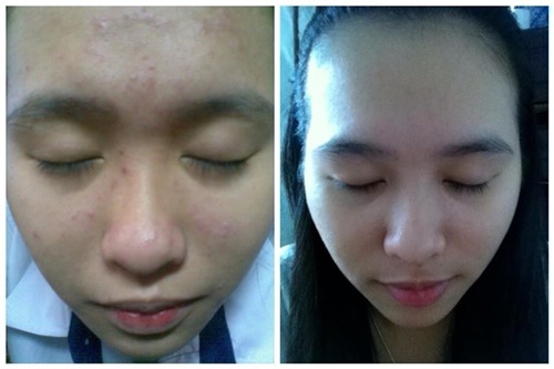 Ngâm bẹ nha đam với giấm rồi bôi lên da 3 lần/tuần, da vừa trắng bật 2 tông mà mụn bong không còn 1 nốt