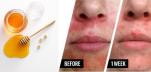 Bị mụn chi chít, cô nàng này đã sử dụng mật ong để đắp mặt và đây là kết quả