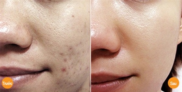 Đây chính là thần dược trị thâm "1 phát ăn ngay" có giá chỉ vài ngàn đồng