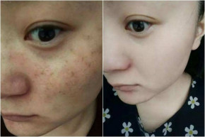 Chỉ với nắm rau chưa đến 3 nghìn da đen nhẻm, thâm nám cũng biến mất hoàn toàn