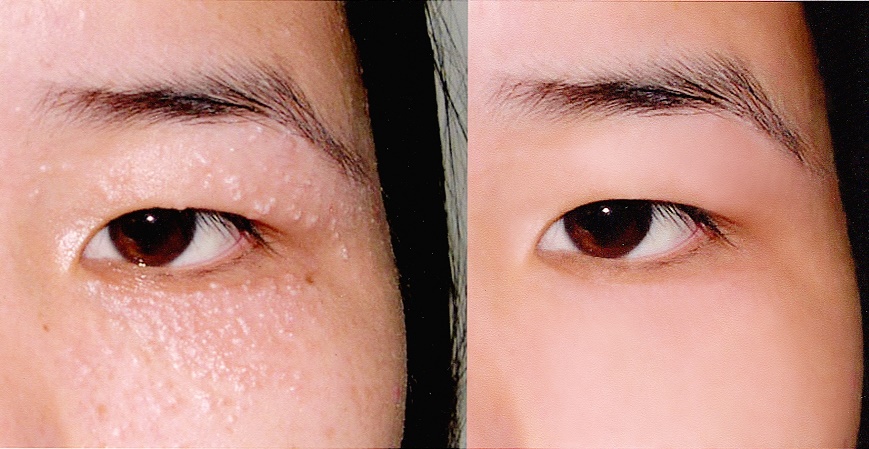 3 HỖN HỢP ĐIỀU TRỊ MỤN THỊT QUANH MẮT SIÊU HIỆU QUẢ