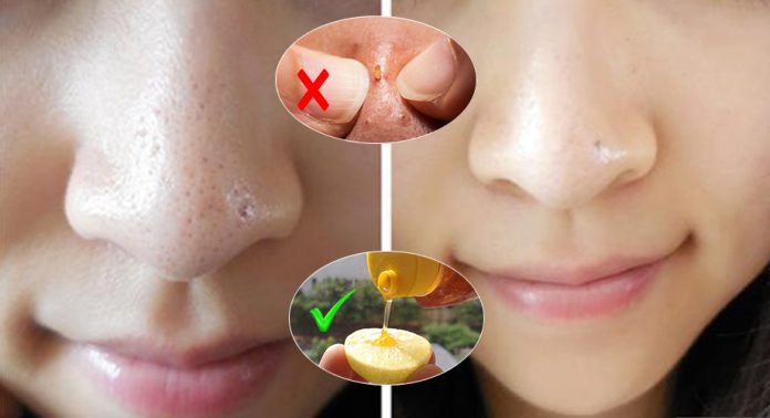 GIÃ TỪ MỤN ĐẦU ĐEN LẪN ĐẦU TRẮNG THEO CÁCH HOÀN TOÀN TỰ NHIÊN